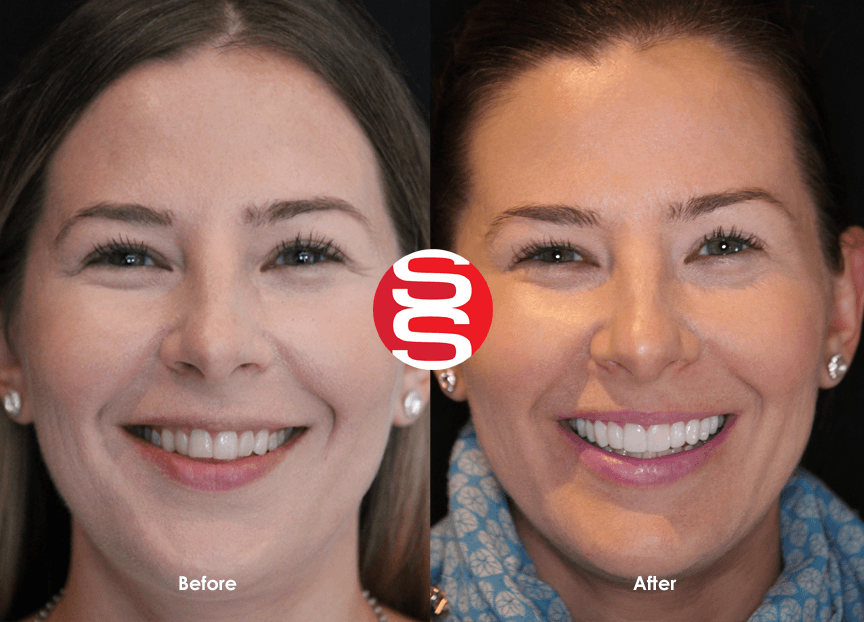 Ashley Before - After