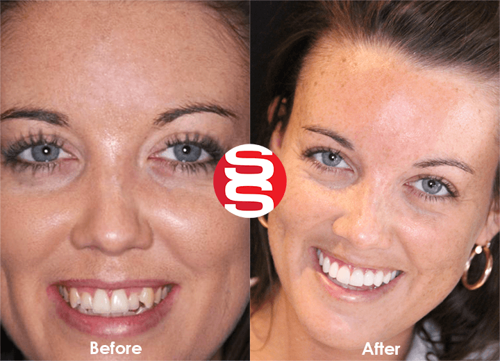 Ashley Before - After