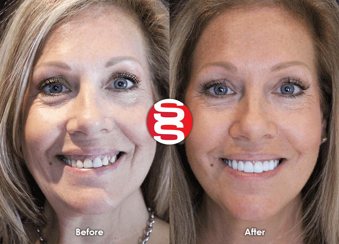 Gum Lift + Porcelain Veneers