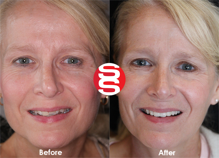 Gum Lift + Porcelain Veneers