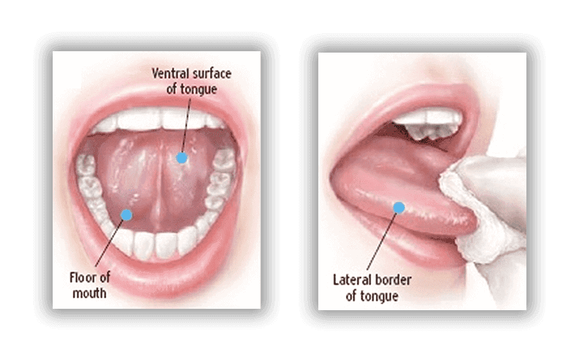 Tongue Surface