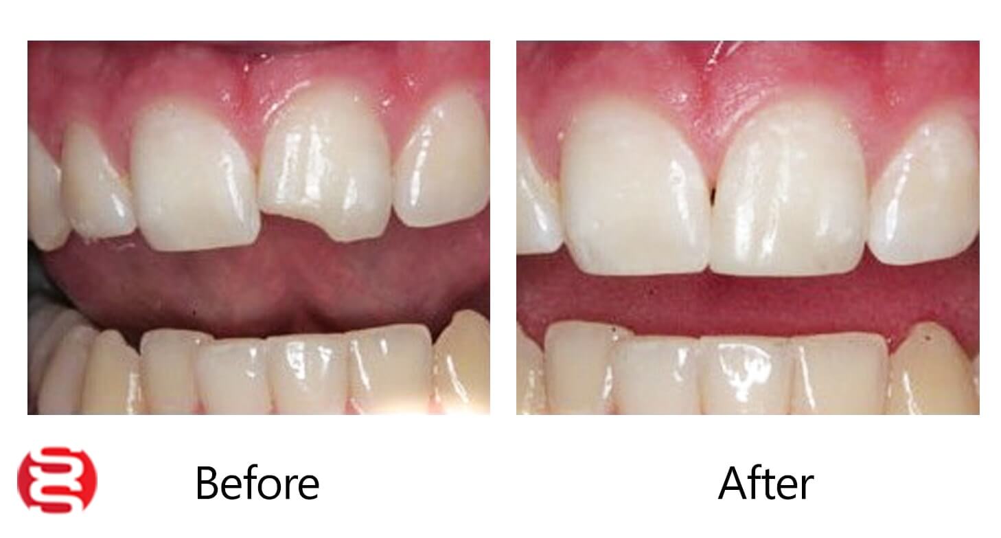 In-office Bonding Before and After