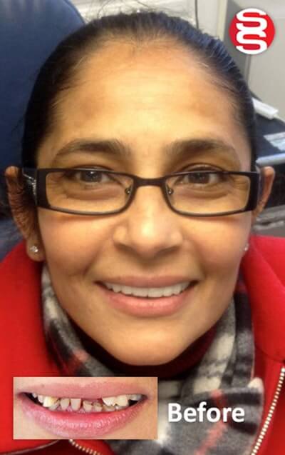 Damaged Teeth Reconstruction Before and After 