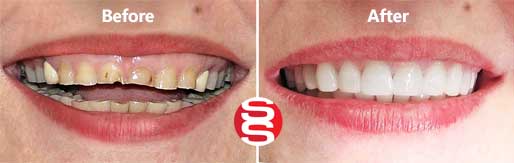 Worn Teeth Reconstruction Before and After 
