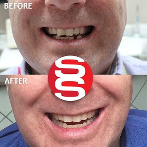 Dental Gap Filling Before and After