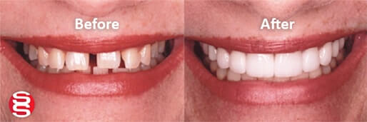Gaps Between Teeth Before and After 