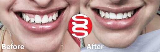 Gum Lifting Treatment 