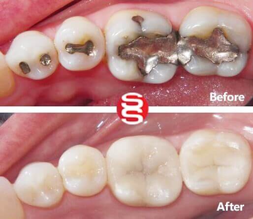 White Fillings Before and After 
