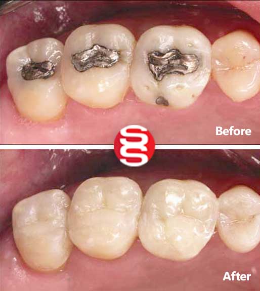 Dental Fillings Before and After 