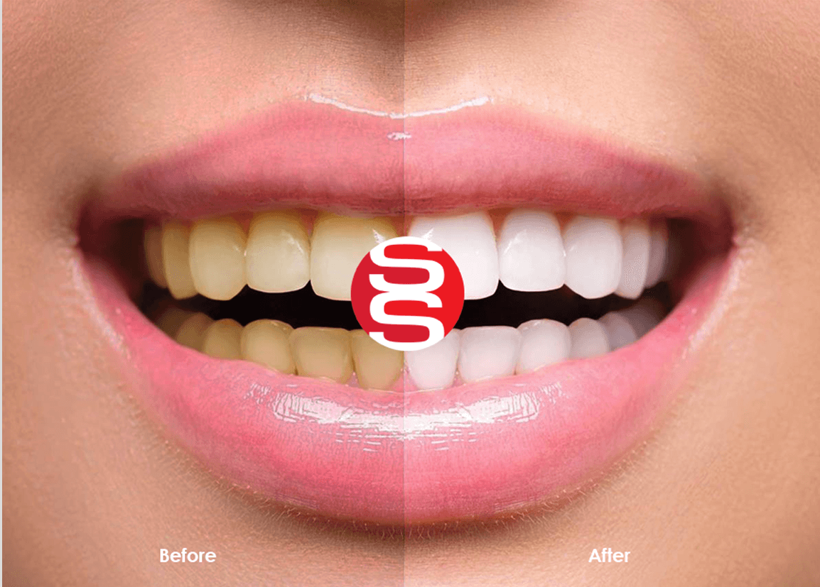Teeth Whitening Treatment