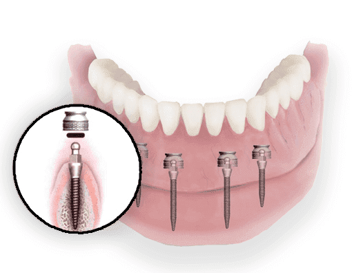 Dental Implant Procedure