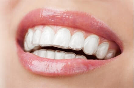Invisible Braces