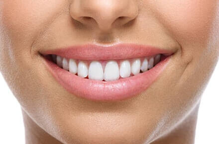 Porcelain Veneers