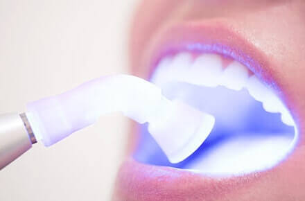 Teeth Whitening